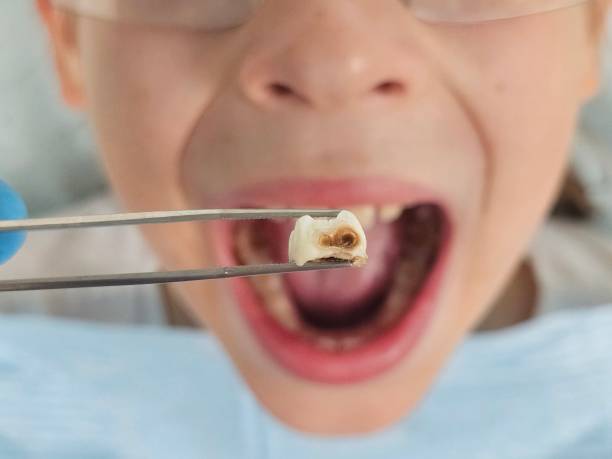 Best Tooth Infection Emergency Dentist  in Piedmont, AL
